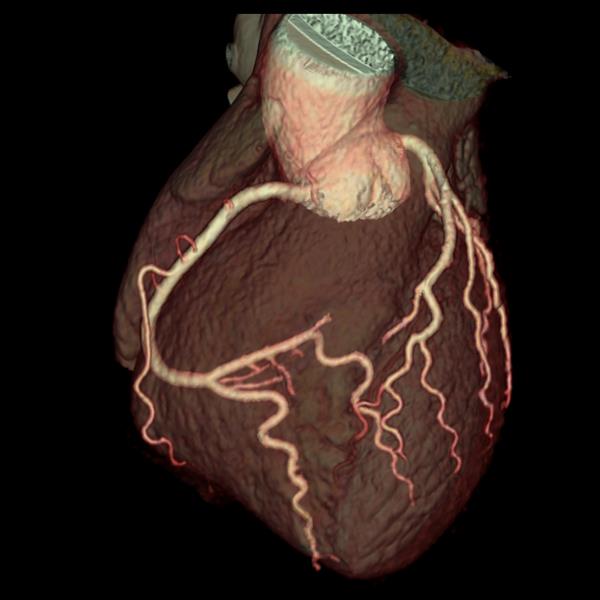 Immagine Cuore3d Con Revolution CT (1)